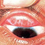 Turning a Blind Eye (Trachoma)
