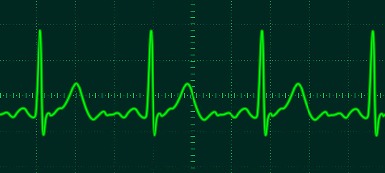 internal heart monitor